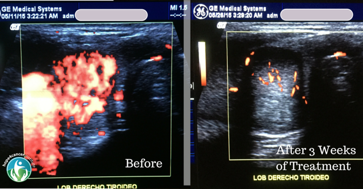 Sono-Photo Dynamic Therapy Chokes Blood Supply to Tumors